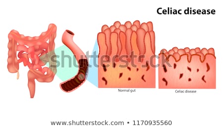 Foto stock: Celiac Coeliac Intestine Disease