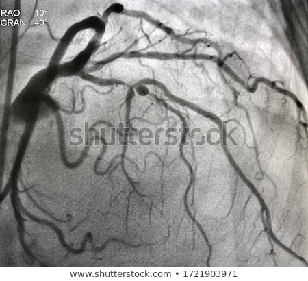 Stock foto: Coronary Artery Disease