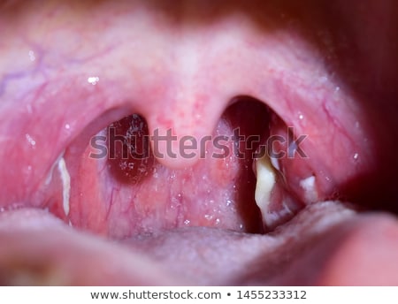 ストックフォト: A Human Mouth Tonsillitis Infection