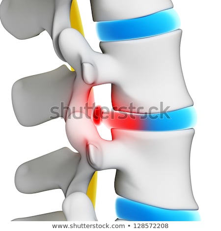 Foto stock: 3d Rendered Illustration - Herniated Disk