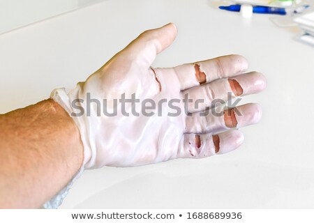 Stock photo: Hand Physiotherapy To Recover A Finger