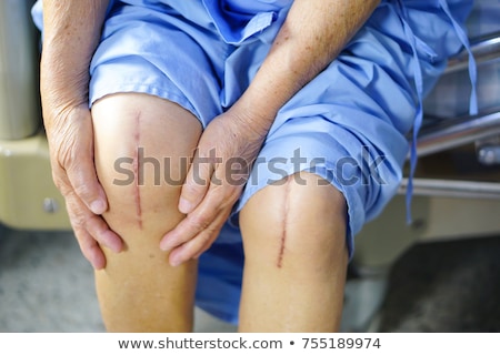 [[stock_photo]]: Knee Replacement Staples