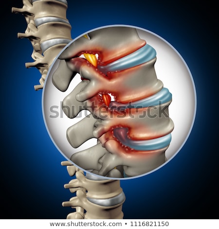 [[stock_photo]]: Spinal Stenosis Concept