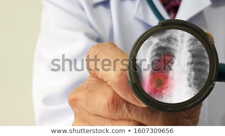 Foto stock: Virus Lung Infection
