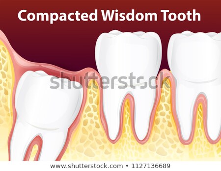 Foto stock: A Compacted Wisdom Tooth