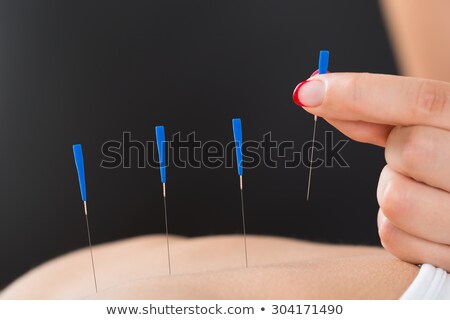 [[stock_photo]]: Therapist Putting Acupuncture Needle On Womans Back