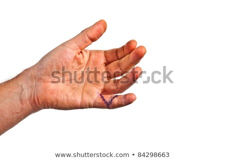 Сток-фото: Hand With An Operation Wound At The Small Finger