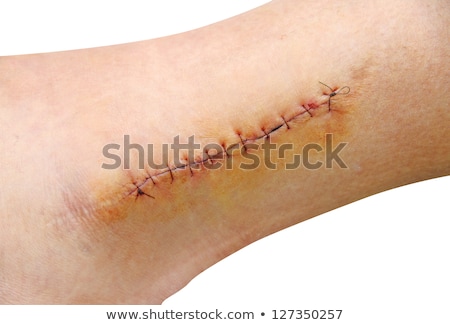 Foto stock: Stitching Up A Wound