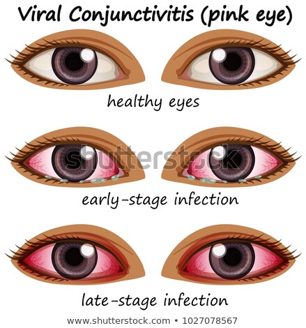 [[stock_photo]]: Viral Conjuctivitis In Human Eyes