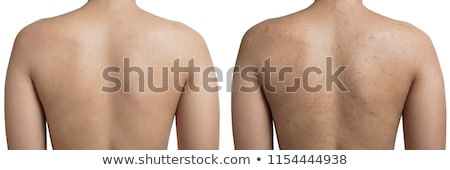 Stock photo: Back Of Human Female With Pain Spots