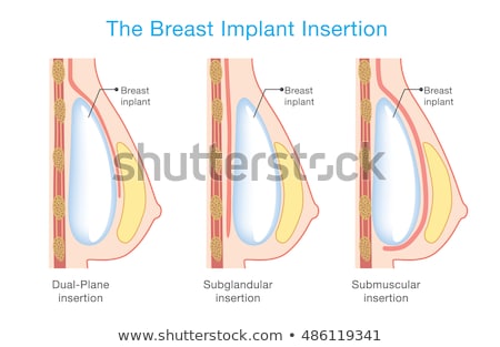 Stock fotó: Breast Implant Diagram