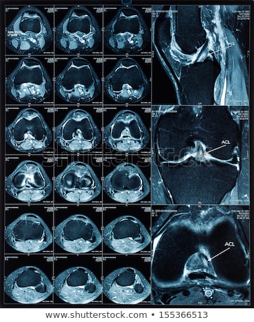 Stok fotoğraf: Magnetic Resonance Tomography Mrt Images Of Knee