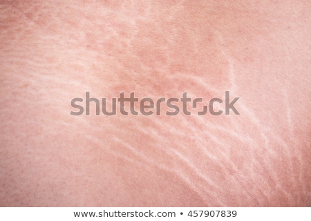 Foto d'archivio: Stretch Marks Macro