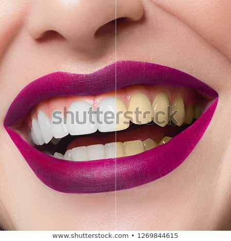Stok fotoğraf: Beauty Care Part Of Woman Face Perfect Smile Before And After Bleaching Dental Care And Whitening
