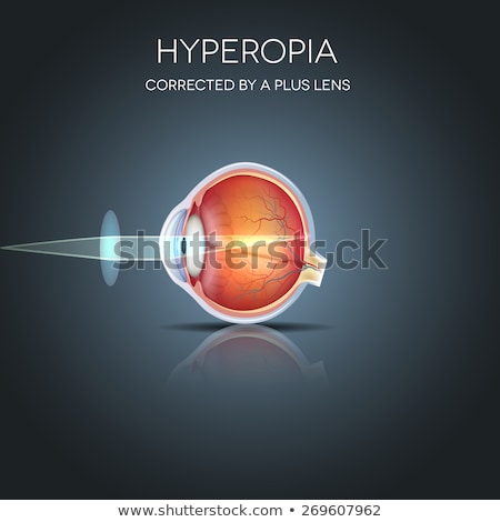 Stock photo: Hyperopia And Hyperopia Corrected By A Plus Lens Eye Vision Dis
