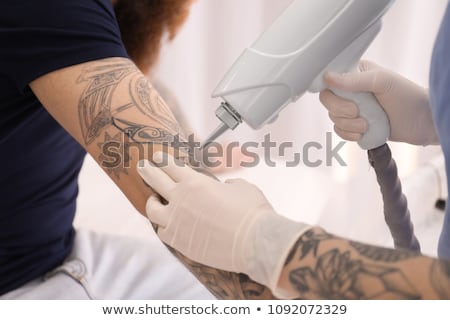 Foto stock: Laser Tattoo Removal On Mans Hand