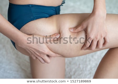 Stockfoto: Woman Cellulite
