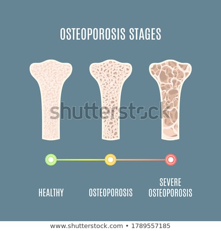 Stok fotoğraf: Stages Of Osteoporosis