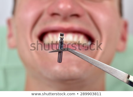 Stok fotoğraf: Dental Implant In Tweezers