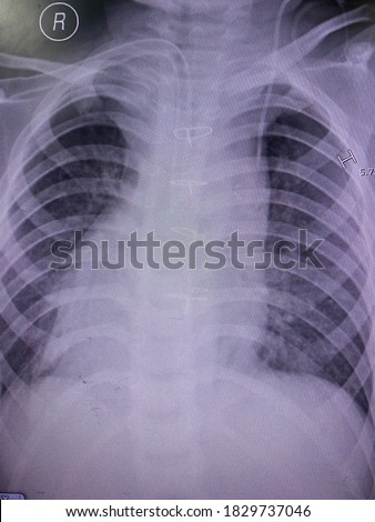 ストックフォト: Pneumothorax Diagnosis Medical Concept