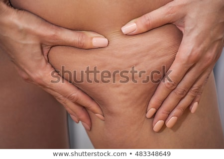 Stock foto: Cellulite