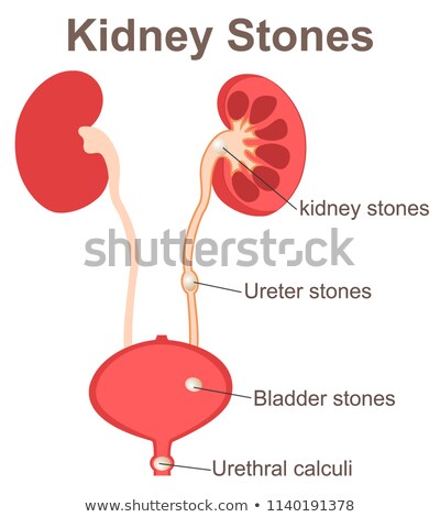 Foto stock: Stones In The Kidney Urinary Bladder And Ureter