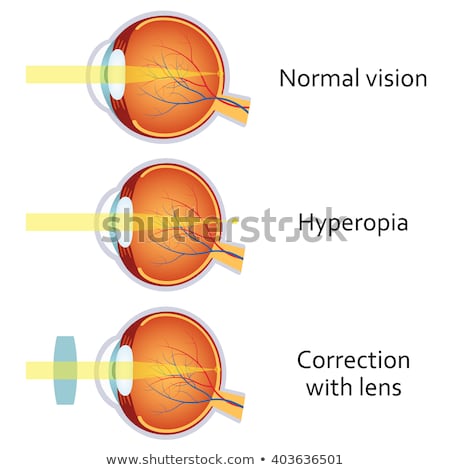 Hyperopia Vision Disorder Foto d'archivio © Neokryuger