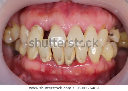 Stock foto: Gum Disease Inflammation Bacteria