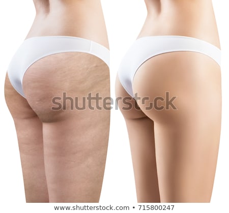 Zdjęcia stock: Woman Leg Cellulite