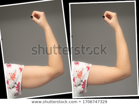 Stock fotó: Liposuction Medical Treatment And Comparison