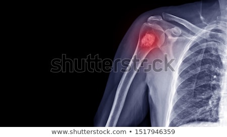 Zdjęcia stock: Bone Cancer