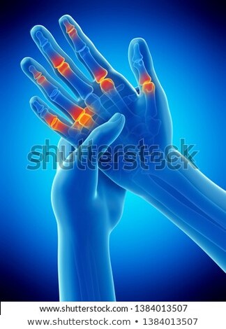 Foto stock: 3d Rendered Illustration Of Painful Finger Joints