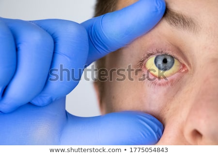 Stockfoto: Hepatitis