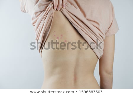 [[stock_photo]]: Bug Bites