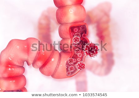 Stock photo: Colon Cancer And Colon Polyps