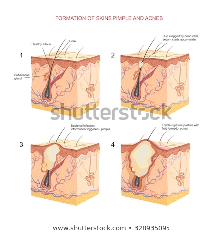 Stock foto: Formation Of Skin Acne Or Pimple