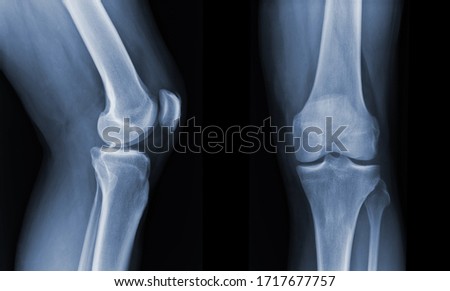 Foto stock: X Ray Knee Radiograph Show State Of Injury