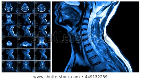 ストックフォト: Magnetic Resonance Imaging Of The Cervical Spine
