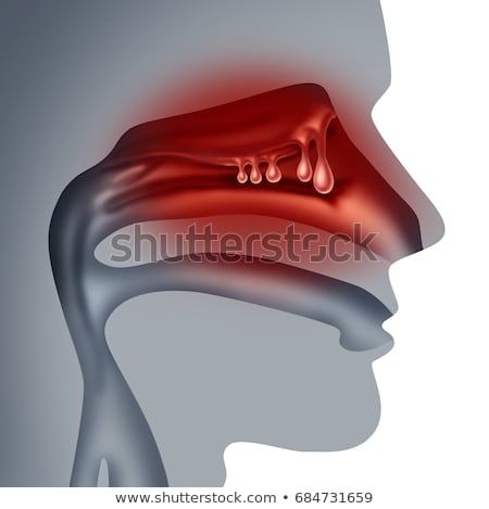 Stock fotó: Nasal Polyps