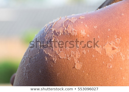 Foto stock: Eeling · doloroso · quemadura · solar