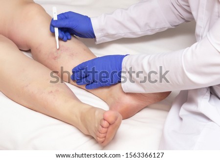 Foto stock: People With Varicose Veins Of The Lower Extremities And Venous T