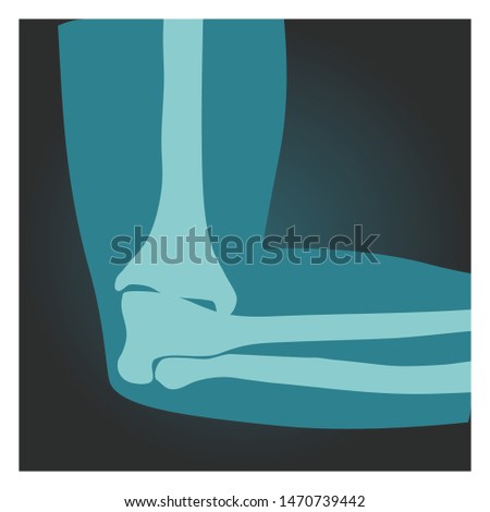 X Ray Shot Of Elbow Side View Human Body Bones Of Hand Radiography Vector Illustration Zdjęcia stock © MarySan