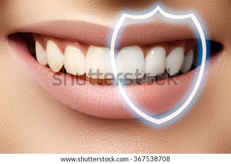 Foto stock: Perfect Smile After Bleaching Dental Care And Whitening Teeth