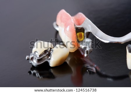 Foto d'archivio: Part Of A Scheletal Prosthesis That Replaces Missing Teeth Through Special Clamping Systems And It C