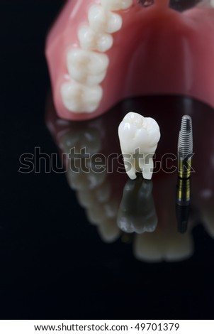 Foto stock: Odelo · de · dientes · dentales · y · plásticos · de · implante · de · muela · del · juicio · humano · real