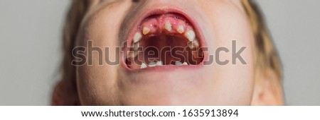 Foto stock: Abnormal Boy Tooth The Extra Narrow Strange Tooth Grew In The Boys Mouth Boy Shows His Crooked To