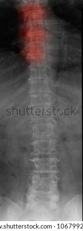 Stock fotó: Diagnosis - Spondylosis Medical Concept With Blurred Background