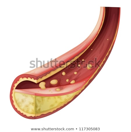 Zdjęcia stock: Cholesterol Blocked Artery