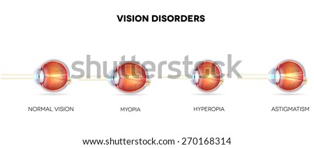 ストックフォト: Eyesight Disorders Normal Eye Astigmatism Hyperopia And Myopi