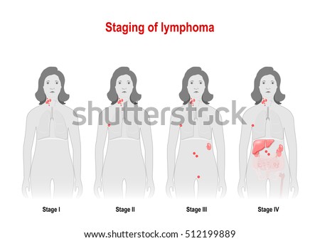 Stockfoto: Staging Of Lymphoma Woman Silhouette With Highlighted Internal